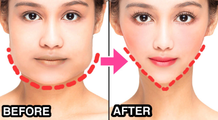How to Achieve a Youthful V-Shape Face - Laser Clinics Singapore